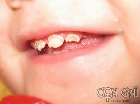 Hậu quả khi trẻ không được chăm sóc răng miệng đúng cách 